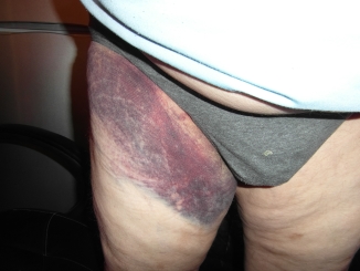 Hematoma small.jpg